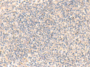 Immunohistochemistry of paraffin-embedded Human tonsil tissue using ADAMTS2 Polyclonal Antibody at dilution of 1:45 (×200)