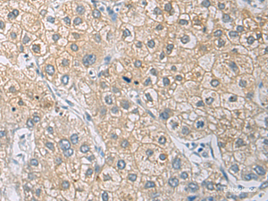 Immunohistochemistry of paraffin-embedded Human liver cancer tissue using IL1RN Polyclonal Antibody at dilution of 1:50 (×200)