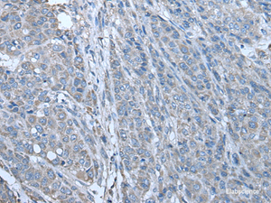 Immunohistochemistry of paraffin-embedded Human liver cancer tissue using ZC3HAV1 Polyclonal Antibody at dilution of 1:70 (×200)