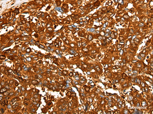 Immunohistochemistry of paraffin-embedded Human liver cancer tissue using PEAR1 Polyclonal Antibody at dilution of 1:25 (×200)