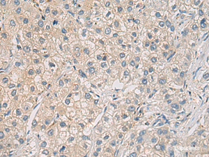 Immunohistochemistry of paraffin-embedded Human liver cancer tissue using WFDC3 Polyclonal Antibody at dilution of 1:40 (×200)