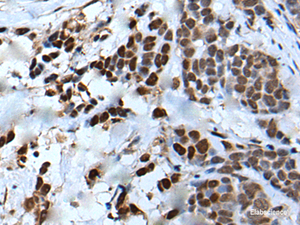 Immunohistochemistry of paraffin-embedded Human thyroid cancer tissue using VEZT Polyclonal Antibody at dilution of 1:50 (×200)