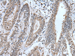 Immunohistochemistry of paraffin-embedded Human liver cancer tissue using UBA52 Polyclonal Antibody at dilution of 1:55 (×200)