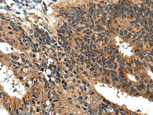 Immunohistochemistry of paraffin-embedded Human colorectal cancer tissue using BMPER Polyclonal Antibody at dilution of 1:40 (×200)