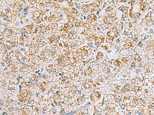Immunohistochemistry of paraffin-embedded Human liver cancer tissue using INS (C-peptide) Polyclonal Antibody at dilution of 1:40 (×200)
