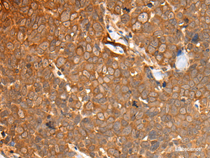 Immunohistochemistry of paraffin-embedded Human thyroid cancer tissue using CAD Polyclonal Antibody at dilution of 1:50 (×200)