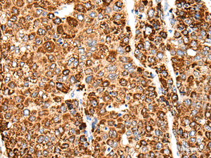 Immunohistochemistry of paraffin-embedded Human liver cancer tissue using CACNG5 Polyclonal Antibody at dilution of 1:50 (×200)