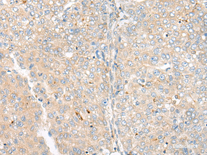 Immunohistochemistry of paraffin-embedded Human liver cancer tissue using CAMK2A Polyclonal Antibody at dilution of 1:55 (×200)