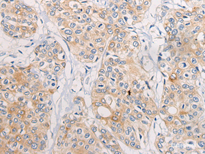 Immunohistochemistry of paraffin-embedded Human prost at e cancer tissue using CPD Polyclonal Antibody at dilution of 1:70 (×200)