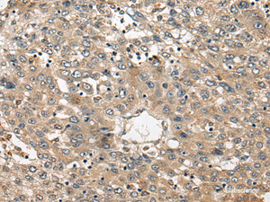 Immunohistochemistry of paraffin-embedded Human liver cancer tissue using FUT4 Polyclonal Antibody at dilution of 1:40 (×200)