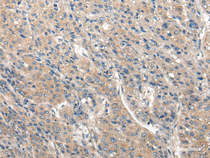 Immunohistochemistry of paraffin-embedded Human liver cancer tissue using CLIC6 Polyclonal Antibody at dilution of 1:40 (×200)