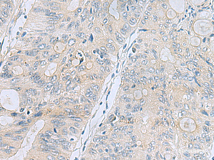 Immunohistochemistry of paraffin-embedded Human colorectal cancer tissue using APOBR Polyclonal Antibody at dilution of 1:35 (×200)