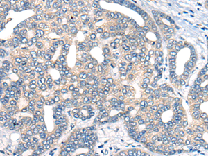 Immunohistochemistry of paraffin-embedded Human liver cancer tissue using AURKA Polyclonal Antibody at dilution of 1:40 (×200)