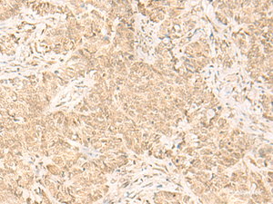 Immunohistochemistry of paraffin-embedded Human ovarian cancer tissue using IL32 Polyclonal Antibody at dilution of 1:45 (×200)