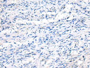 Immunohistochemistry of paraffin-embedded Human ovarian cancer tissue using FGF11 Polyclonal Antibody at dilution of 1:50 (×200)