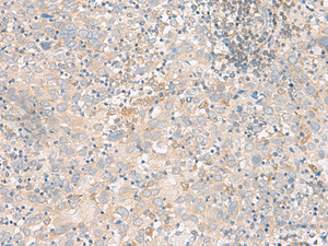 Immunohistochemistry of paraffin-embedded Human cervical cancer tissue using FGF13 Polyclonal Antibody at dilution of 1:45 (×200)