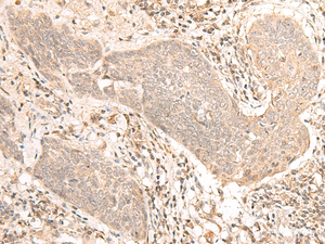 Immunohistochemistry of paraffin-embedded Human esophagus cancer tissue using VPS50 Polyclonal Antibody at dilution of 1:30 (×200)
