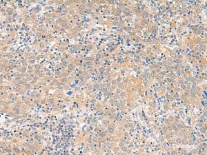 Immunohistochemistry of paraffin-embedded Human cervical cancer tissue using GALP Polyclonal Antibody at dilution of 1:45 (×200)