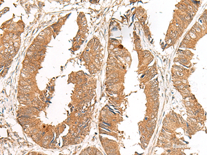 Immunohistochemistry of paraffin-embedded Human colorectal cancer tissue using GCC2 Polyclonal Antibody at dilution of 1:50 (×200)