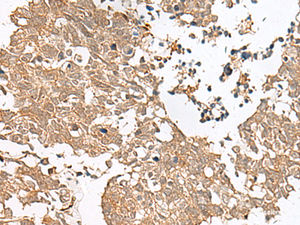 Immunohistochemistry of paraffin-embedded Human lung cancer tissue using GRASP Polyclonal Antibody at dilution of 1:60 (×200)