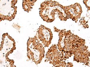 Immunohistochemistry of paraffin-embedded Human thyroid cancer tissue using GFI1B Polyclonal Antibody at dilution of 1:40 (×200)