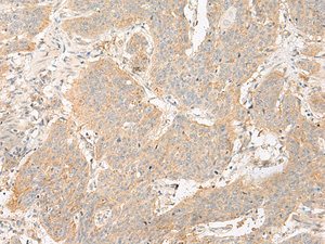 Immunohistochemistry of paraffin-embedded Human esophagus cancer tissue using GP6 Polyclonal Antibody at dilution of 1:40 (×200)