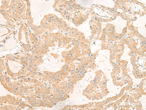 Immunohistochemistry of paraffin-embedded Human thyroid cancer tissue using GNAT3 Polyclonal Antibody at dilution of 1:40 (×200)