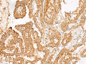Immunohistochemistry of paraffin-embedded Human thyroid cancer tissue using ADGRF1 Polyclonal Antibody at dilution of 1:25 (×200)