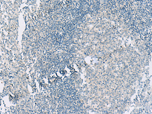 Immunohistochemistry of paraffin-embedded Human tonsil tissue using HASPIN Polyclonal Antibody at dilution of 1:55 (×200)