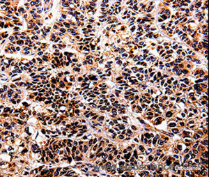 Immunohistochemistry of paraffin-embedded Human lung cancer tissue using IL10RA Polyclonal Antibody at dilution 1:30