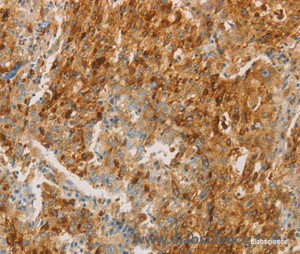 Immunohistochemistry of paraffin-embedded Human gastric cancer tissue using CEACAM8 Polyclonal Antibody at dilution of 1:30