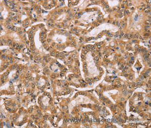 Immunohistochemistry of paraffin-embedded Human thyroid cancer tissue using BGLAP Polyclonal Antibody at dilution of 1:40