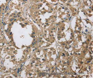 Immunohistochemistry of paraffin-embedded Human thyroid cancer tissue using DSG2 Polyclonal Antibody at dilution 1:70