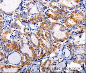 Immunohistochemistry of paraffin-embedded Human thyroid cancer tissue using AP1B1 Polyclonal Antibody at dilution 1:100