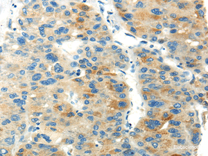 Immunohistochemistry of paraffin-embedded Human liver cancer using PDPN Polyclonal Antibody at dilution of 1/20