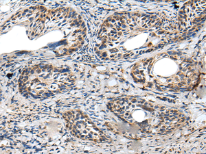 Immunohistochemistry of paraffin-embedded Human cervical cancer tissue using PRNP Polyclonal Antibody at dilution of 1:45 (×200)