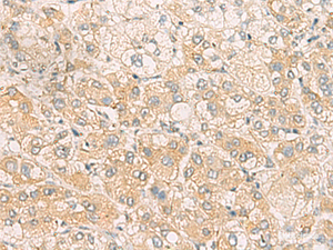 Immunohistochemistry of paraffin-embedded Human liver cancer tissue using SYNGR1 Polyclonal Antibody at dilution of 1:60 (×200)