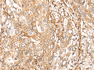 Immunohistochemistry of paraffin-embedded Human gastric cancer tissue using CD99 Polyclonal Antibody at dilution of 1:40 (×200)