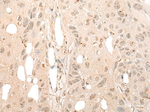 Immunohistochemistry of paraffin-embedded Human esophagus cancer tissue using DDX21 Polyclonal Antibody at dilution of 1:40 (×200)