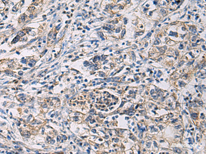 Immunohistochemistry of paraffin-embedded Human gastric cancer tissue using CYTIP Polyclonal Antibody at dilution of 1:100 (×200)