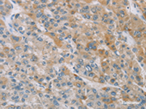 Immunohistochemistry of paraffin-embedded Human liver cancer tissue using ZAK Polyclonal Antibody at dilution of 1:100 (×200)