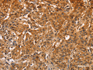Immunohistochemistry of paraffin-embedded Human gastric cancer tissue using ZFP64 Polyclonal Antibody at dilution of 1:60 (×200)