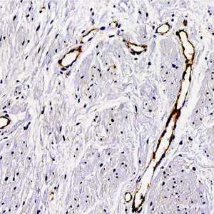 Immunohistochemistry analysis of paraffin-embedded Human hysteromyoma using VWF Polyclonal Antibody at dilution of 1:300.