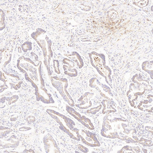 Immunohistochemistry analysis of paraffin-embedded human colon cancer using MMP2 Polyclonal Antibody at dilution of 1:500.