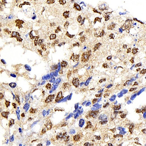 Immunohistochemistry analysis of paraffin-embedded human lung cancer using IkB alpha Polyclonal Antibody at dilution of 1:500.