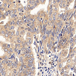 Immunohistochemistry analysis of paraffin-embedded human endometrial cancer using PGR Polyclonal Antibody at dilution of 1:300.