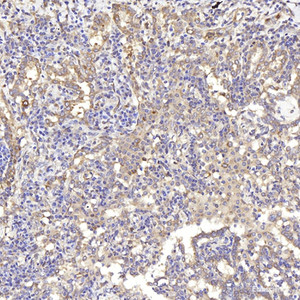 Immunohistochemistry analysis of paraffin-embedded human lung cancer using IKK alpha Polyclonal Antibody at dilution of 1:300.