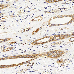 Immunohistochemistry analysis of paraffin-embedded human liver cancer using ITGAV Polyclonal Antibody at dilution of 1:300.