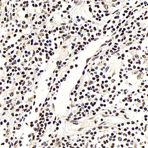 Immunohistochemistry analysis of paraffin-embedded human lung cancer using NFKBIB Polyclonal Antibody at dilution of 1:300.