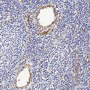 Immunohistochemistry analysis of paraffin-embedded human Lymphoma using LDLR Polyclonal Antibody at dilution of 1:300.